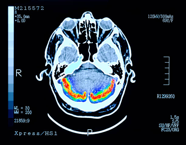 Early Onset Alzheimers